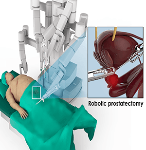 Robotic Prostatectomy