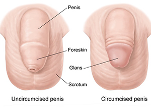 low circumcision