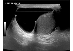 Hydrocelectomy