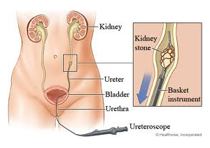 ureteroscopic lithotripsy